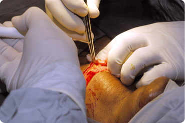 Bariatrics Surgery