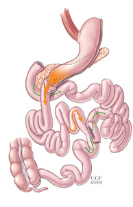 Biliopancreatic Diversion with Duodenal Switch (BPD/DS) Gastric Bypass