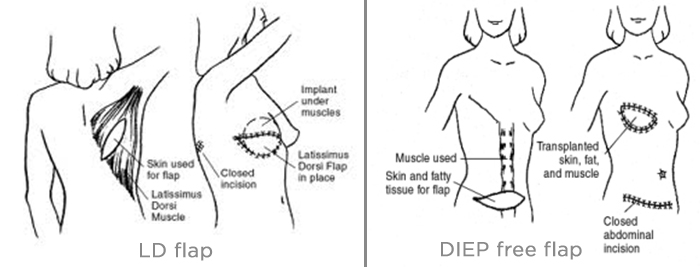 ONCOPLASTIC BREAST RECONSTRUCTION