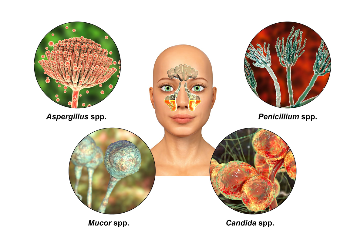 Mucormycosis symptoms